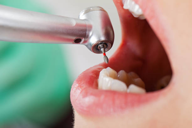 Best Emergency Tooth Extraction in Ellensburg, WA
